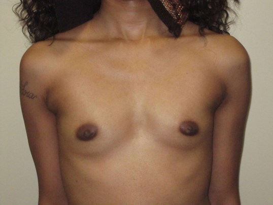 Breast Augmentation Front Before