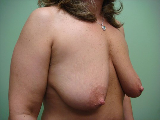 Mastopexy (Breast Lift) Before