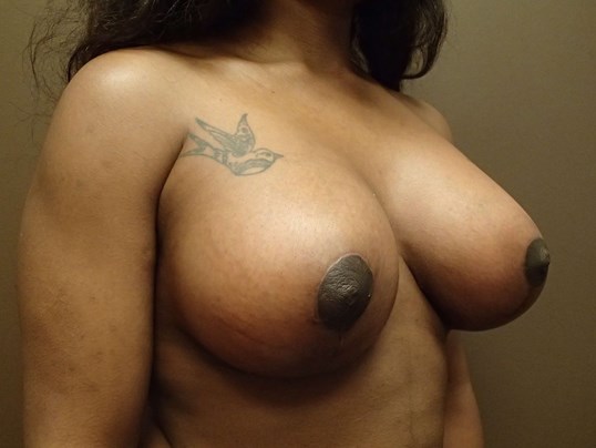 Breast Lift with Implant After