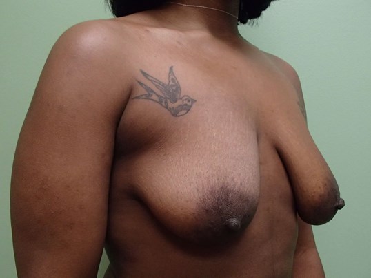 Breast Lift with Implant Before