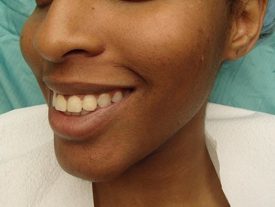 Timeless Dimple (Dimpleplasty) Before