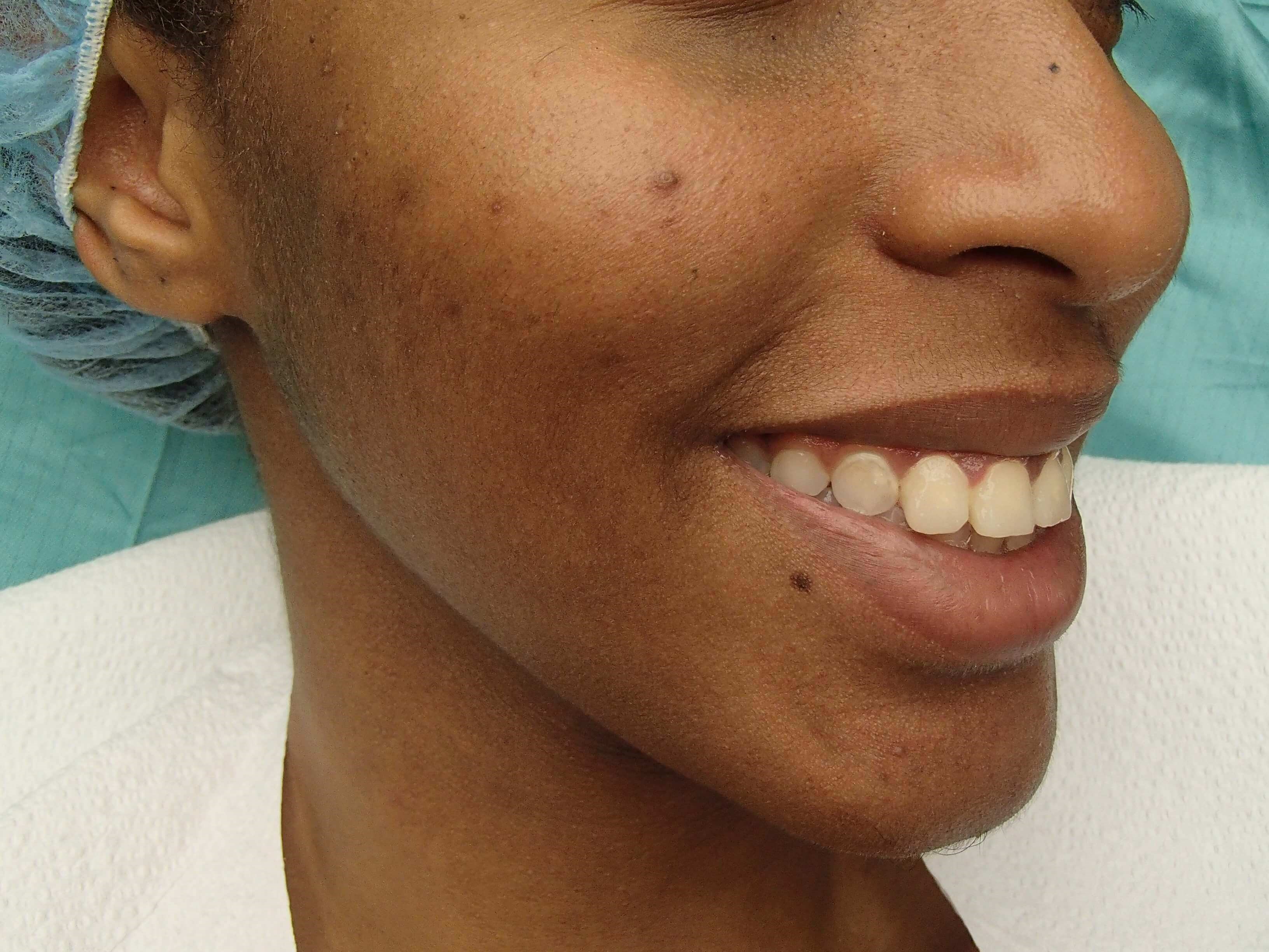 Timeless Dimple (Dimpleplasty) Before