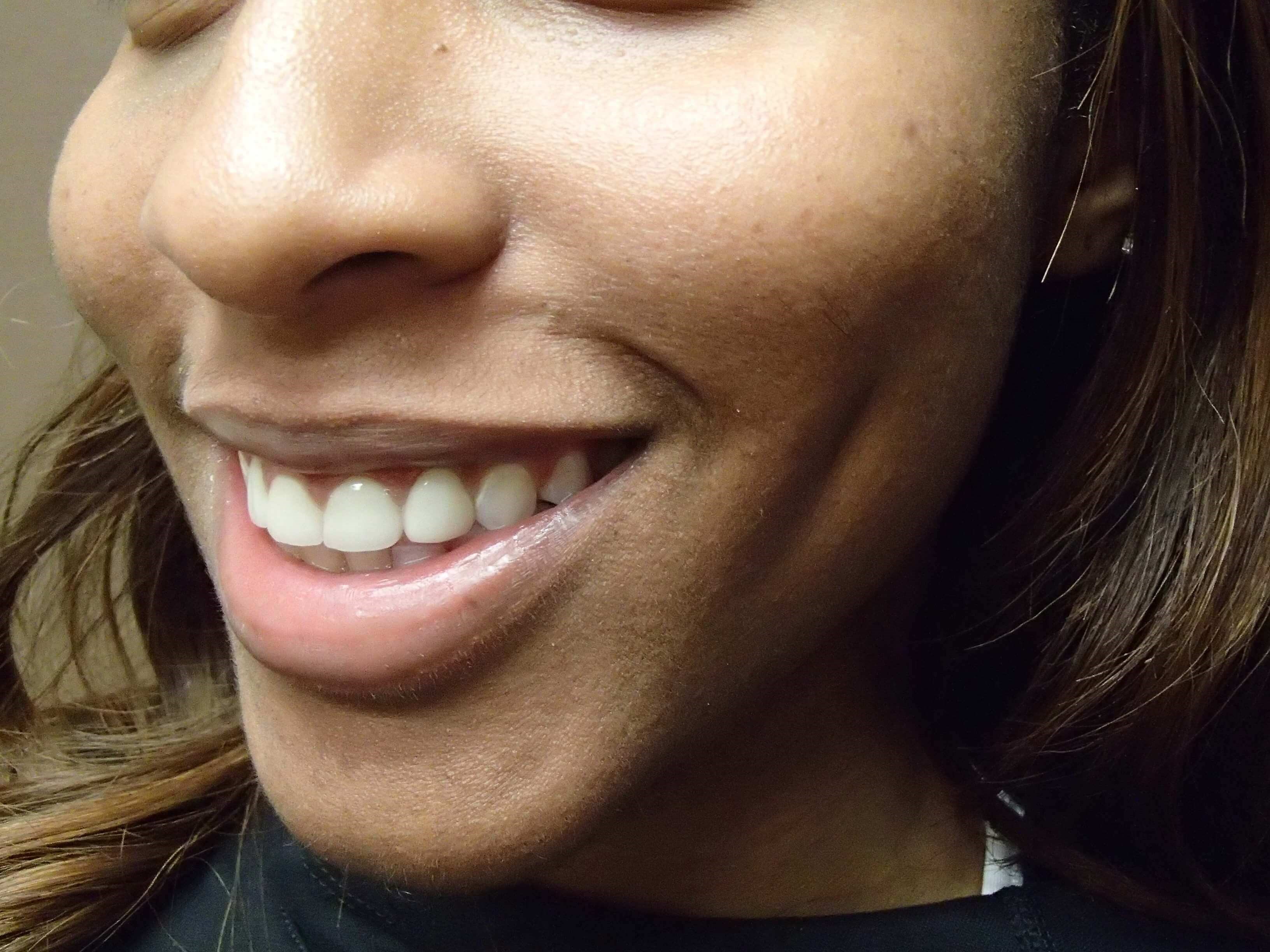 Timeless Dimple (Dimpleplasty) After
