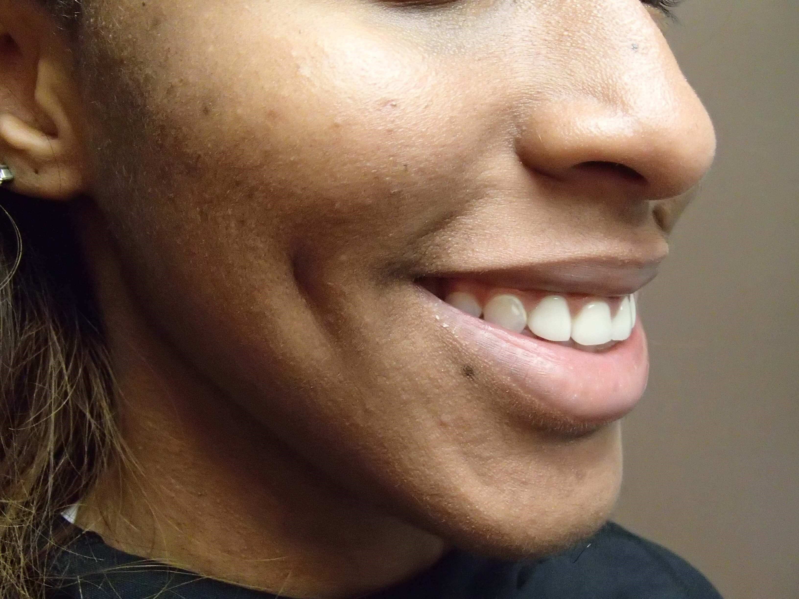 Timeless Dimple (Dimpleplasty) After