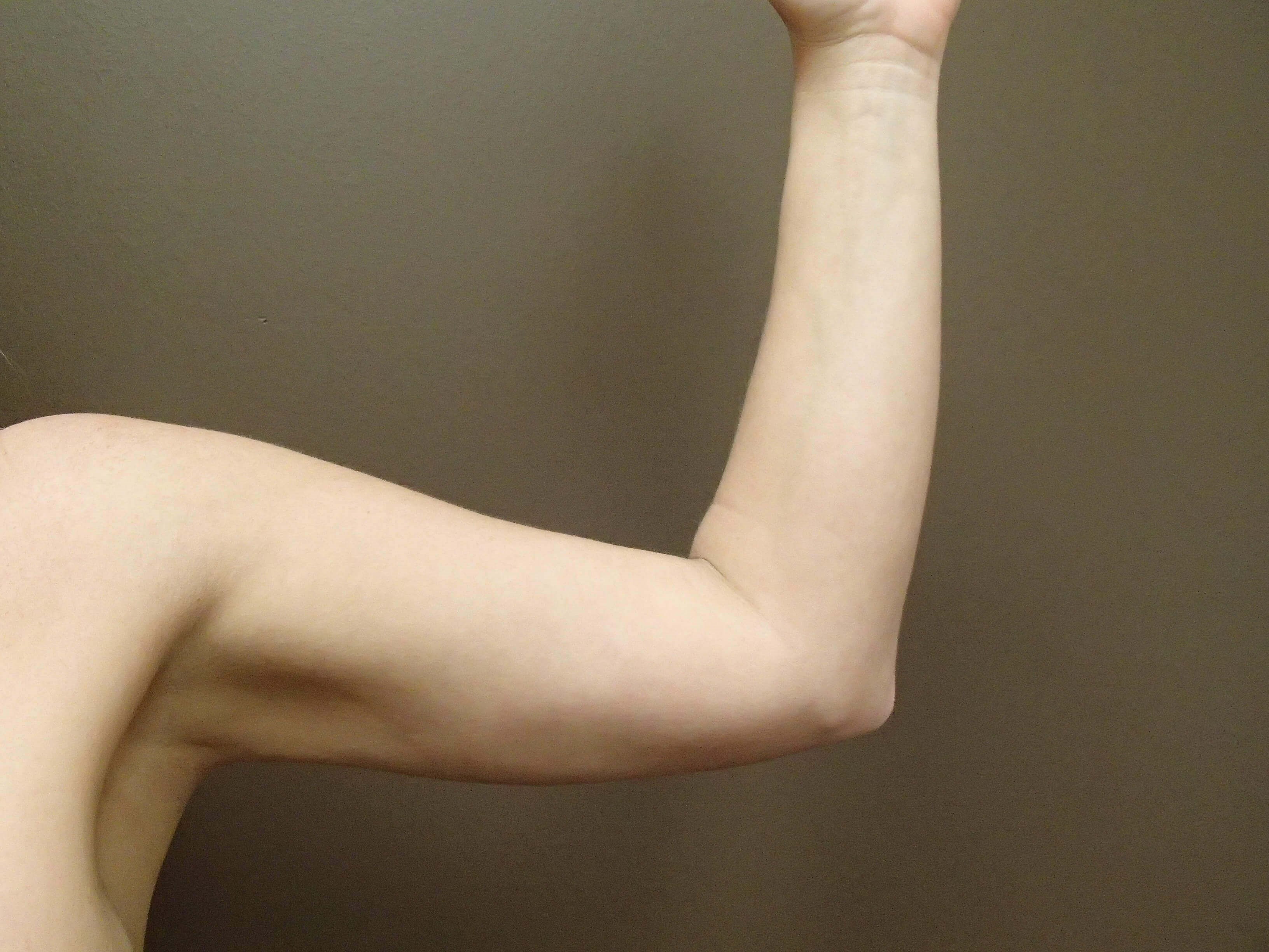 Liposuction After