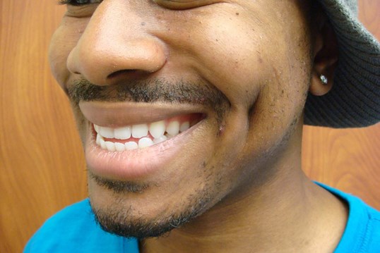 Timeless Dimple (Dimpleplasty) After
