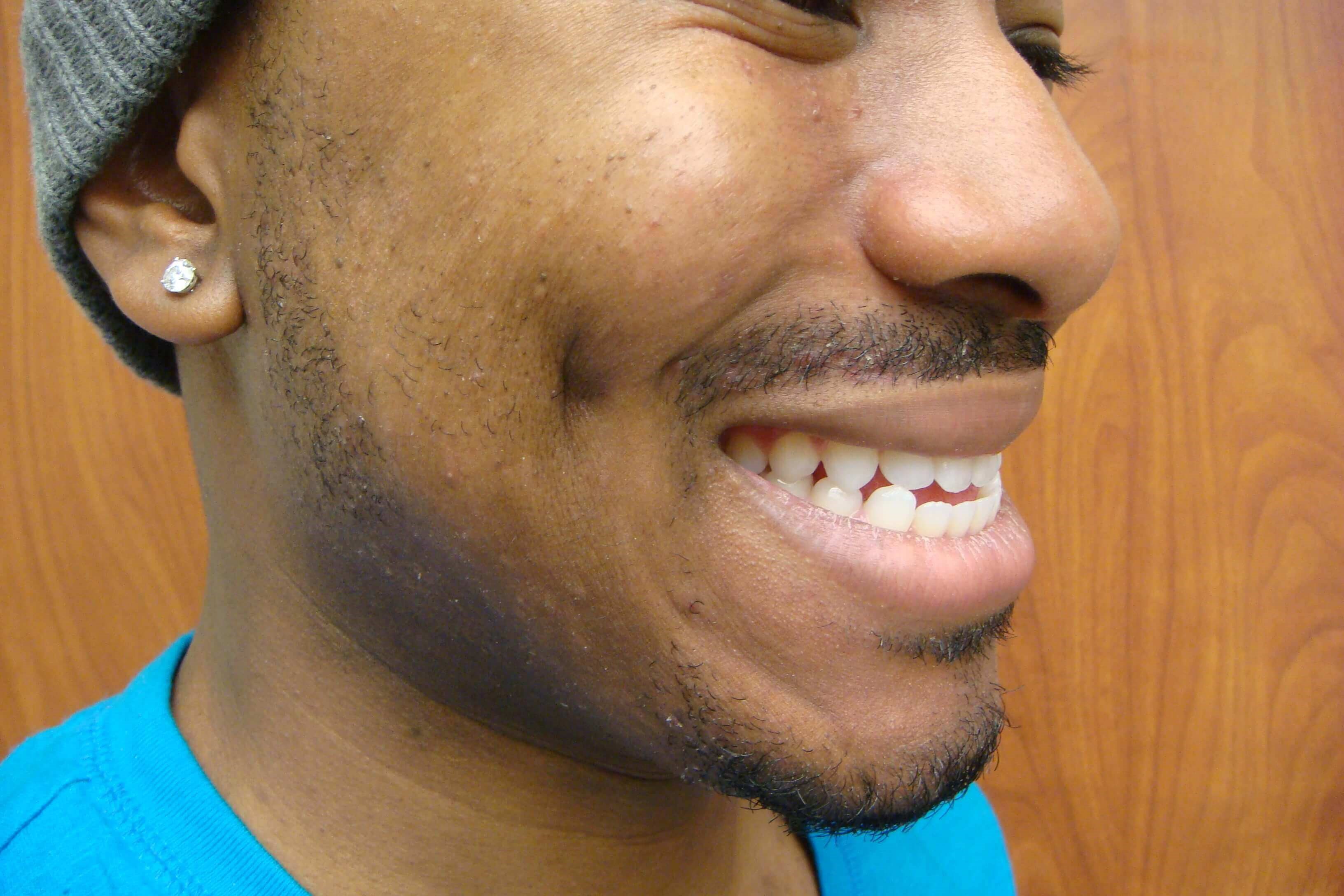 Timeless Dimple (Dimpleplasty) After