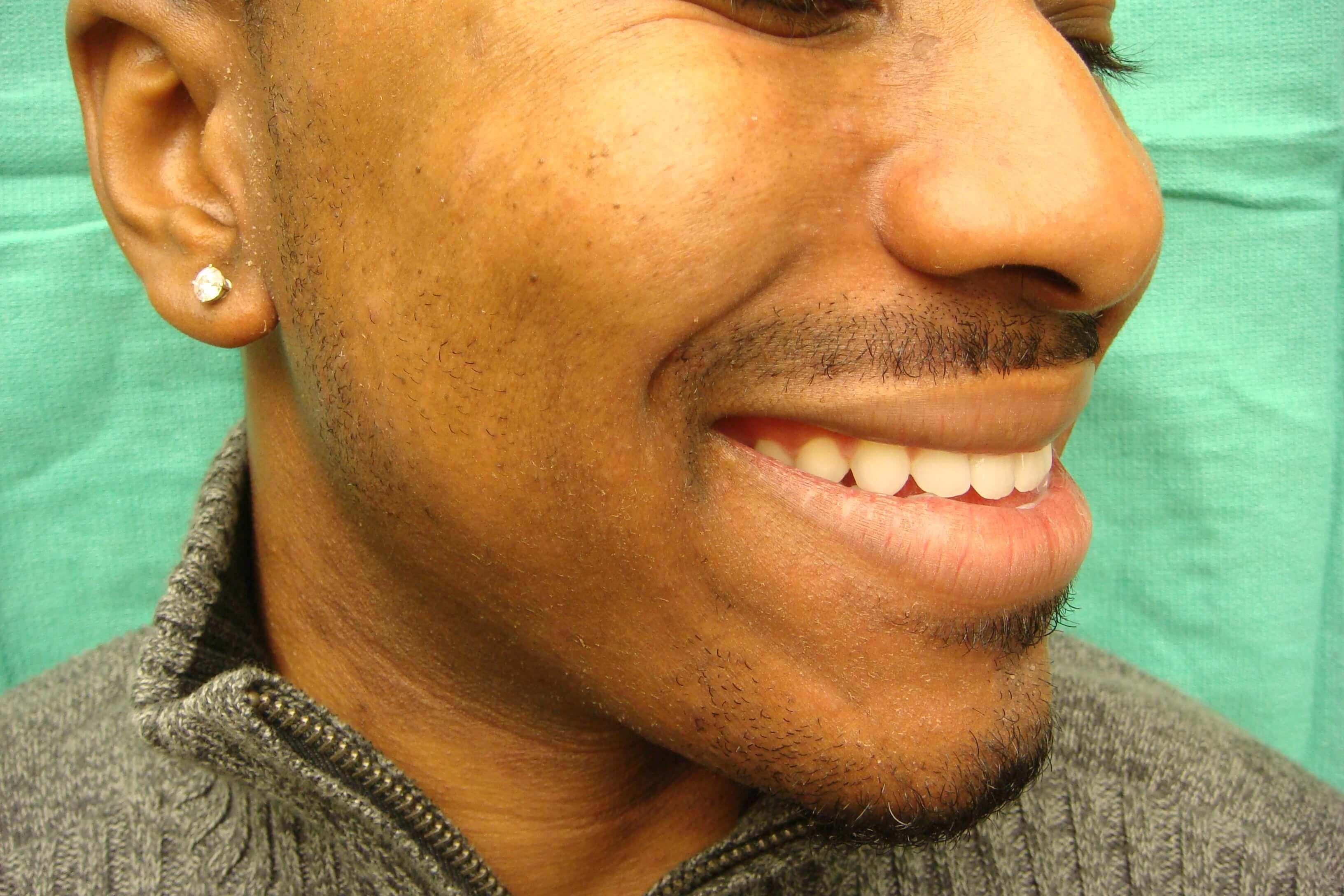 Timeless Dimple (Dimpleplasty) Before