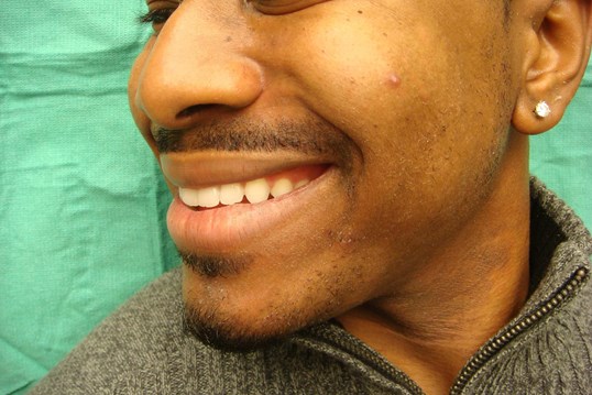 Timeless Dimple (Dimpleplasty) Before