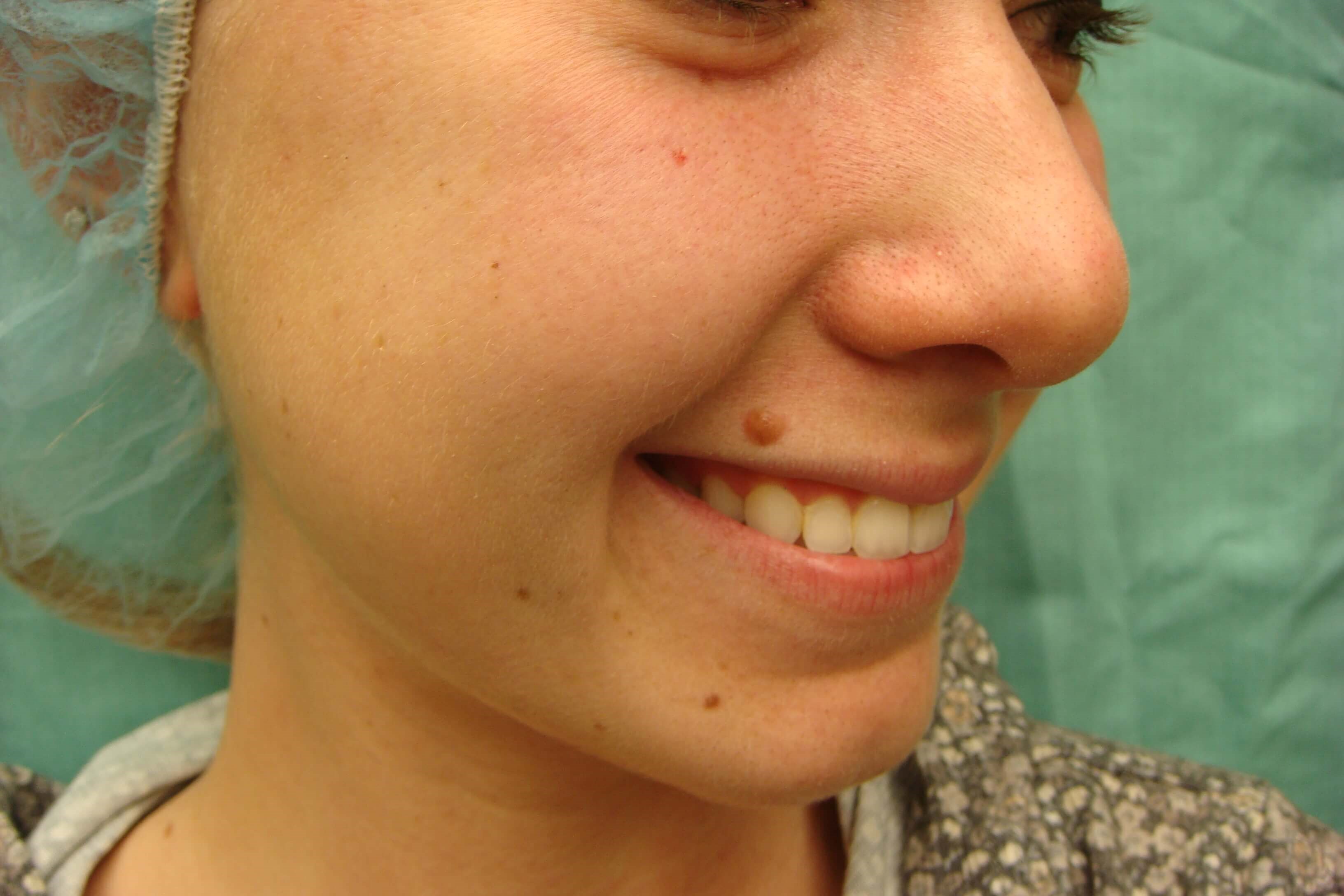 Timeless Dimple (Dimpleplasty) Before