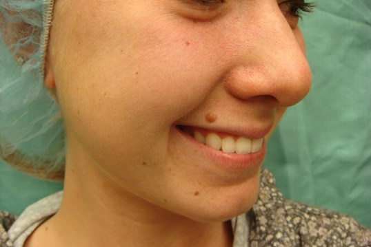 Timeless Dimple (Dimpleplasty) Before