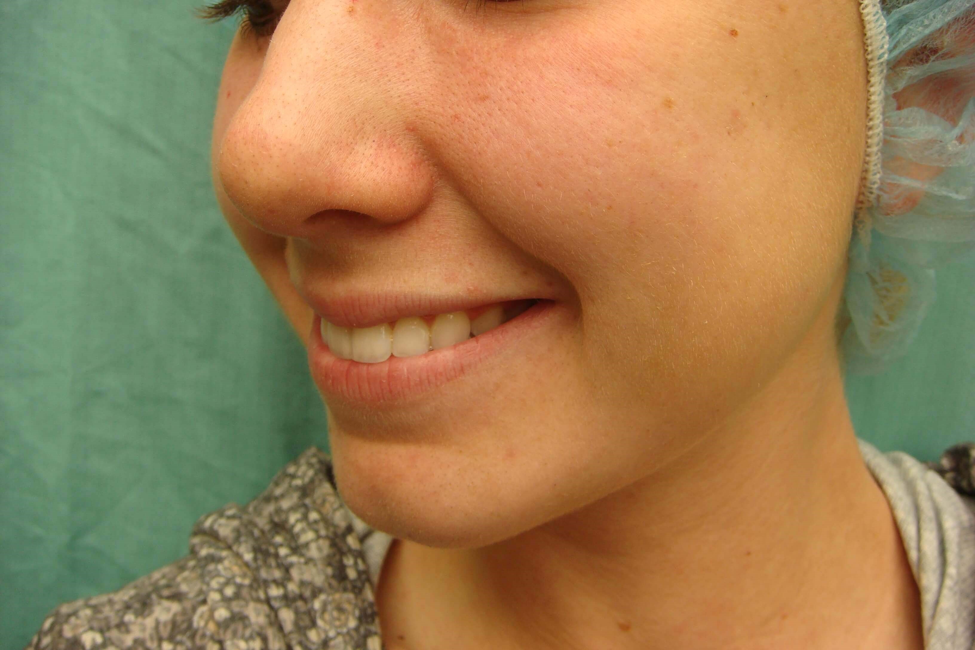 Timeless Dimple (Dimpleplasty) Before