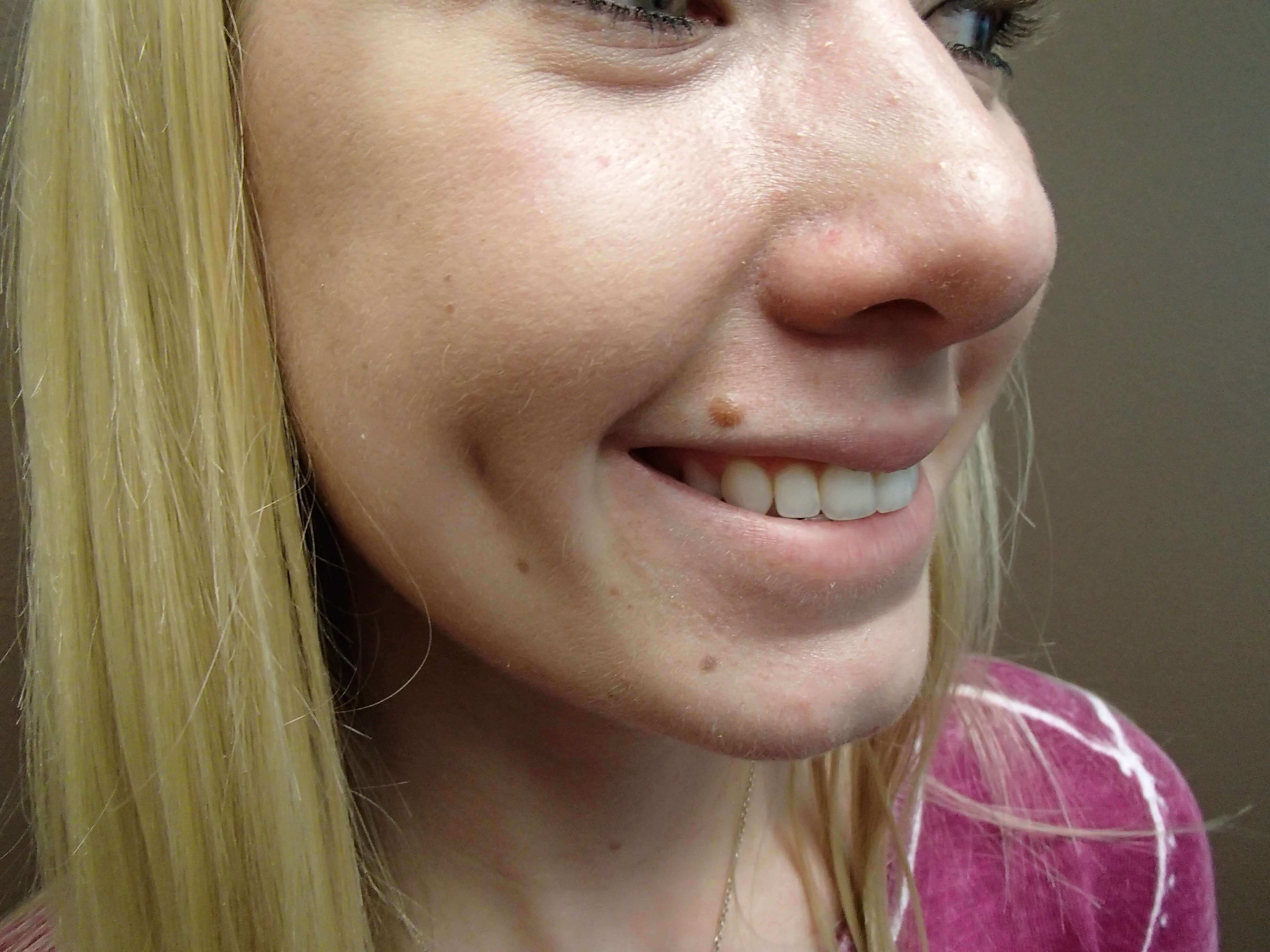 Timeless Dimple (Dimpleplasty) After