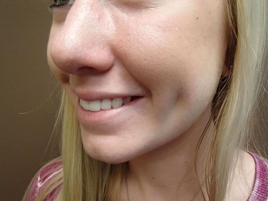 Timeless Dimple (Dimpleplasty) After
