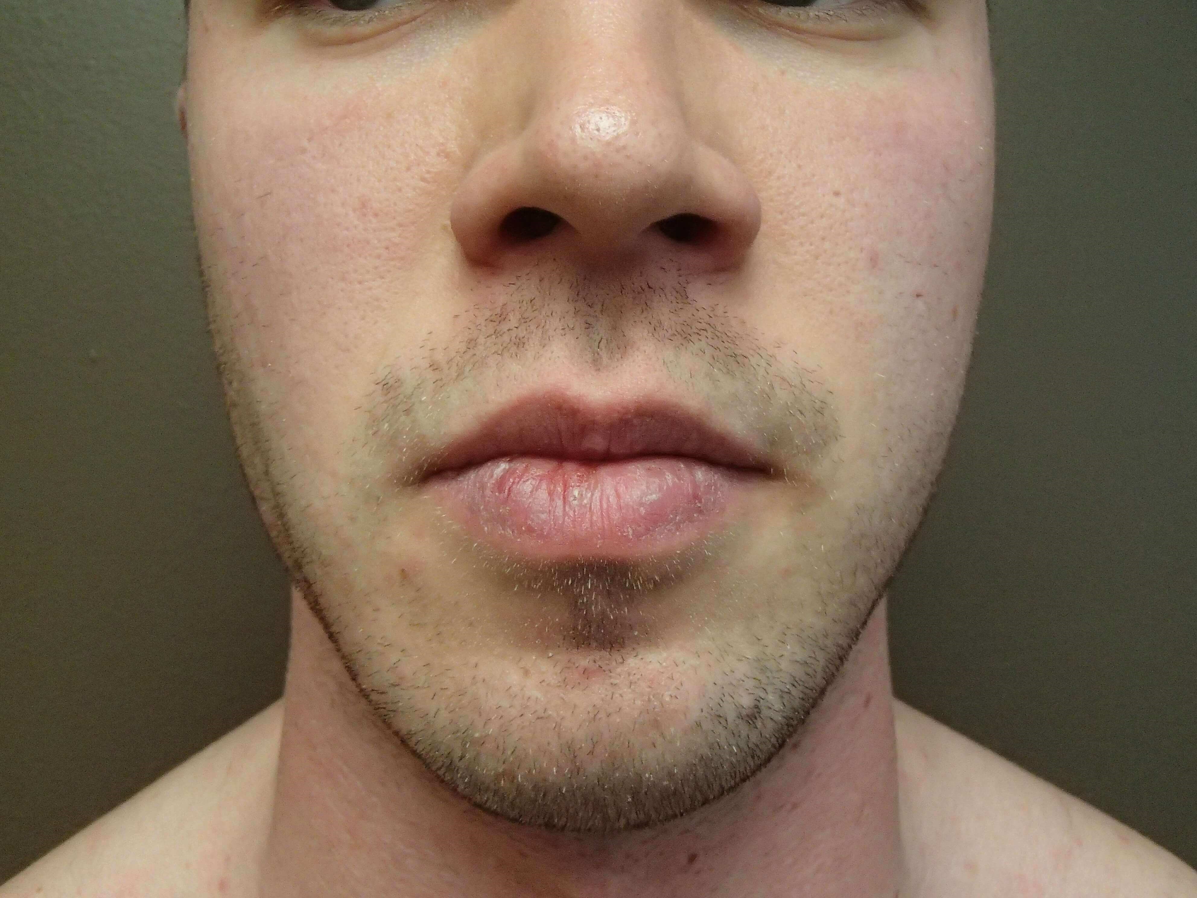 Liposuction of the Face After