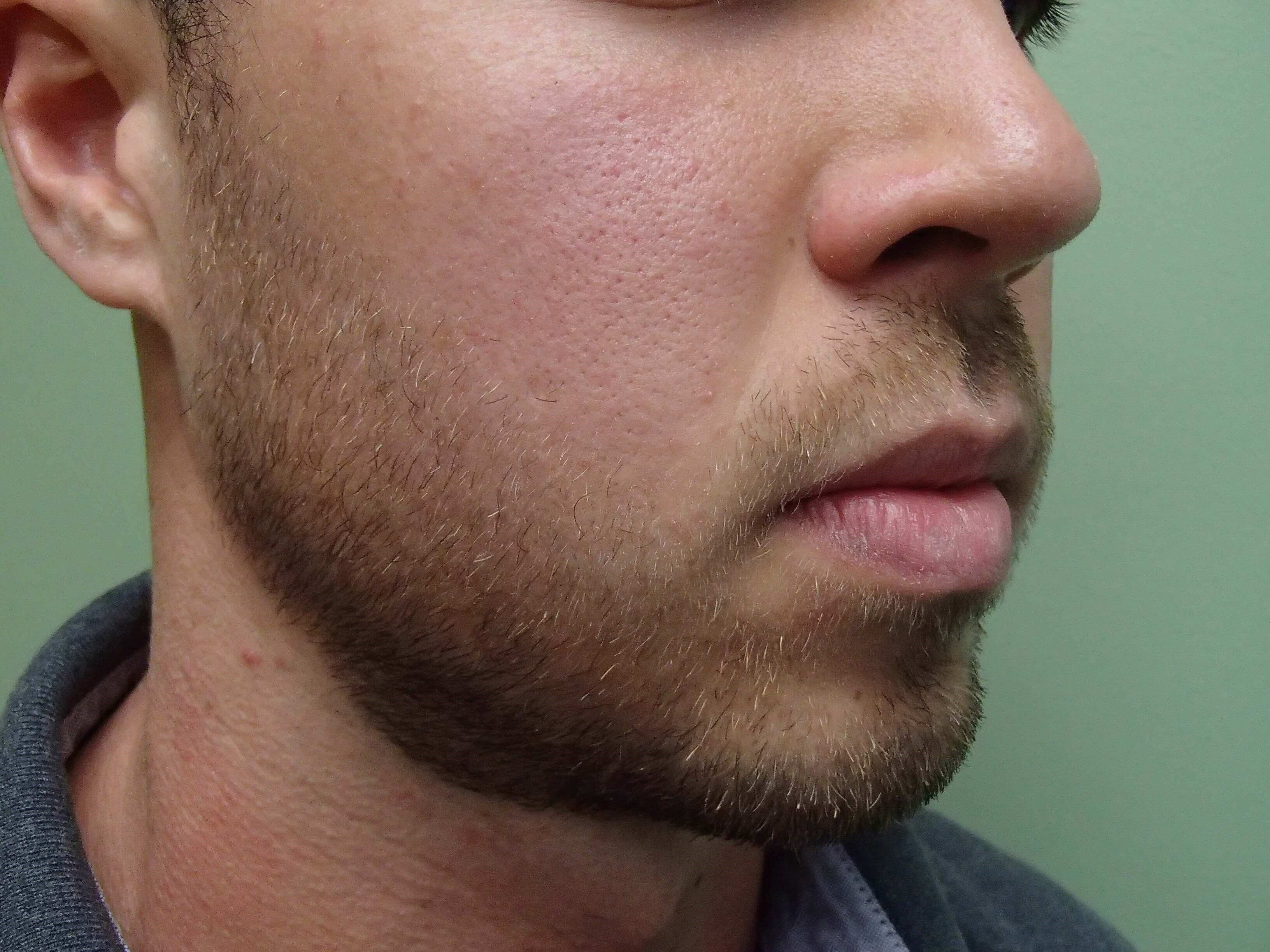 Liposuction of the Face Before