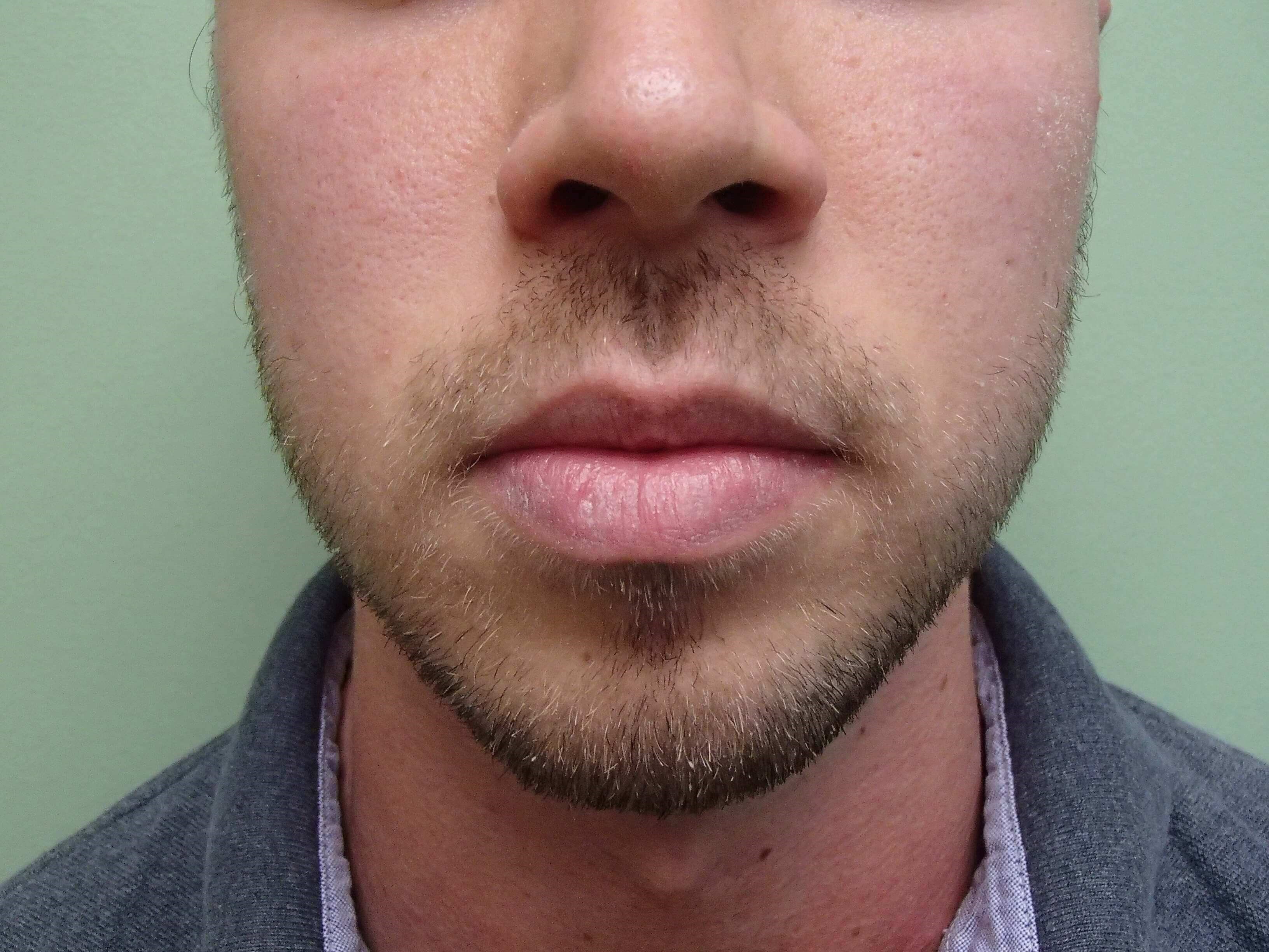 Liposuction of the Face Before