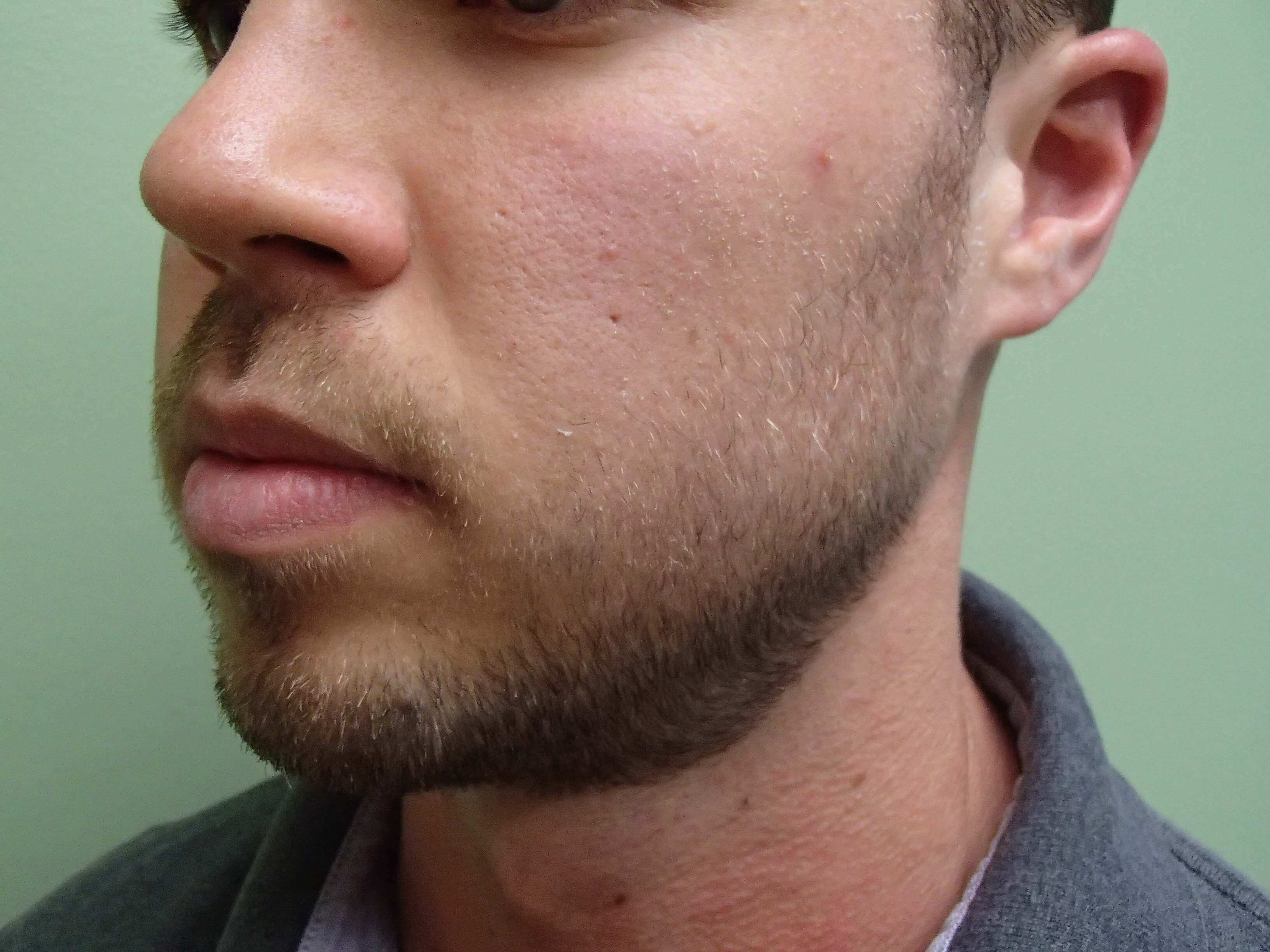 Liposuction of the Face Before