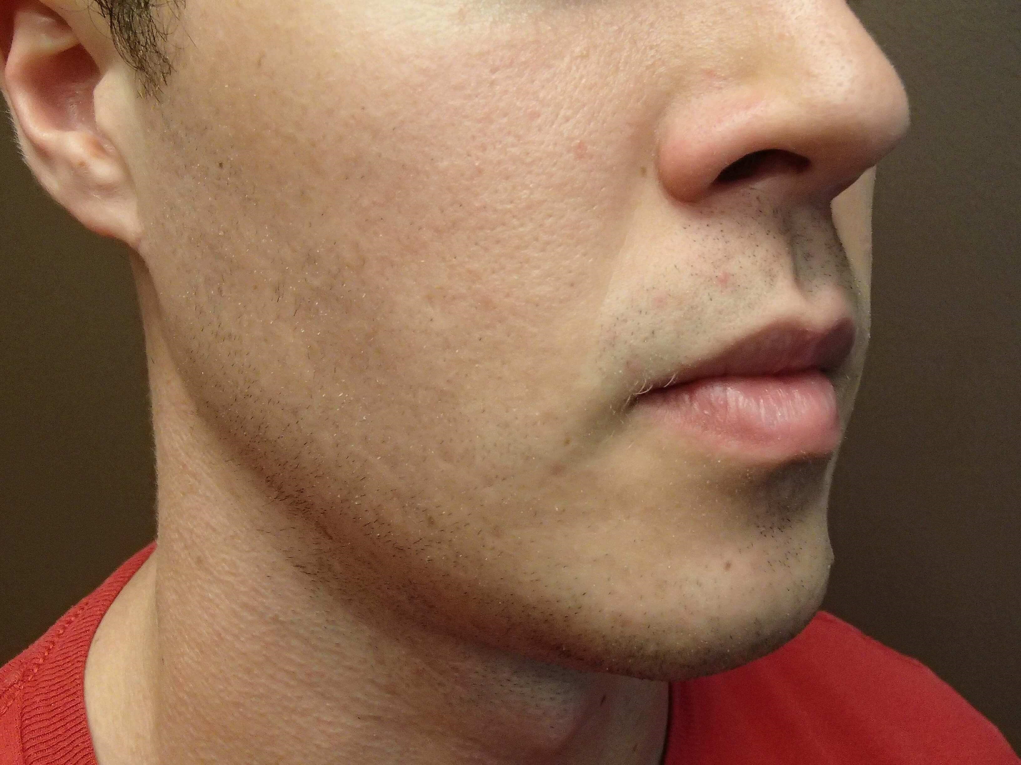 Liposuction of the Face After