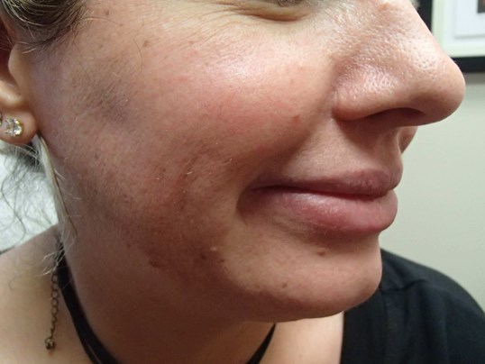 Timeless Dimple (Dimpleplasty) Before