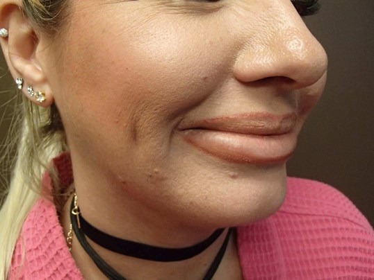Timeless Dimple (Dimpleplasty) After