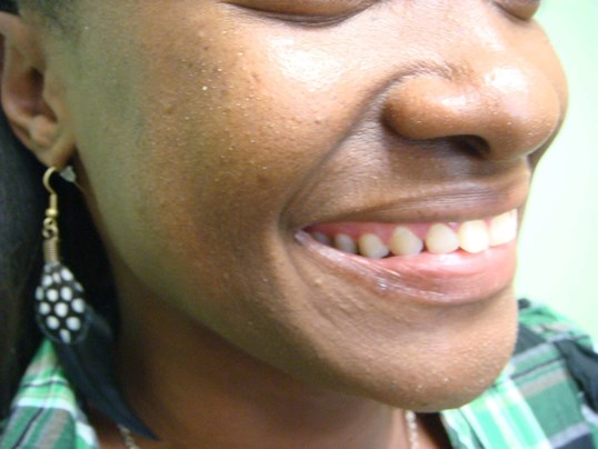 Timeless Dimple (Dimpleplasty) Before