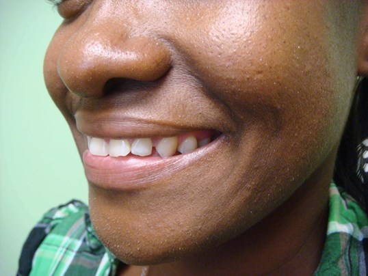 Timeless Dimple (Dimpleplasty) Before