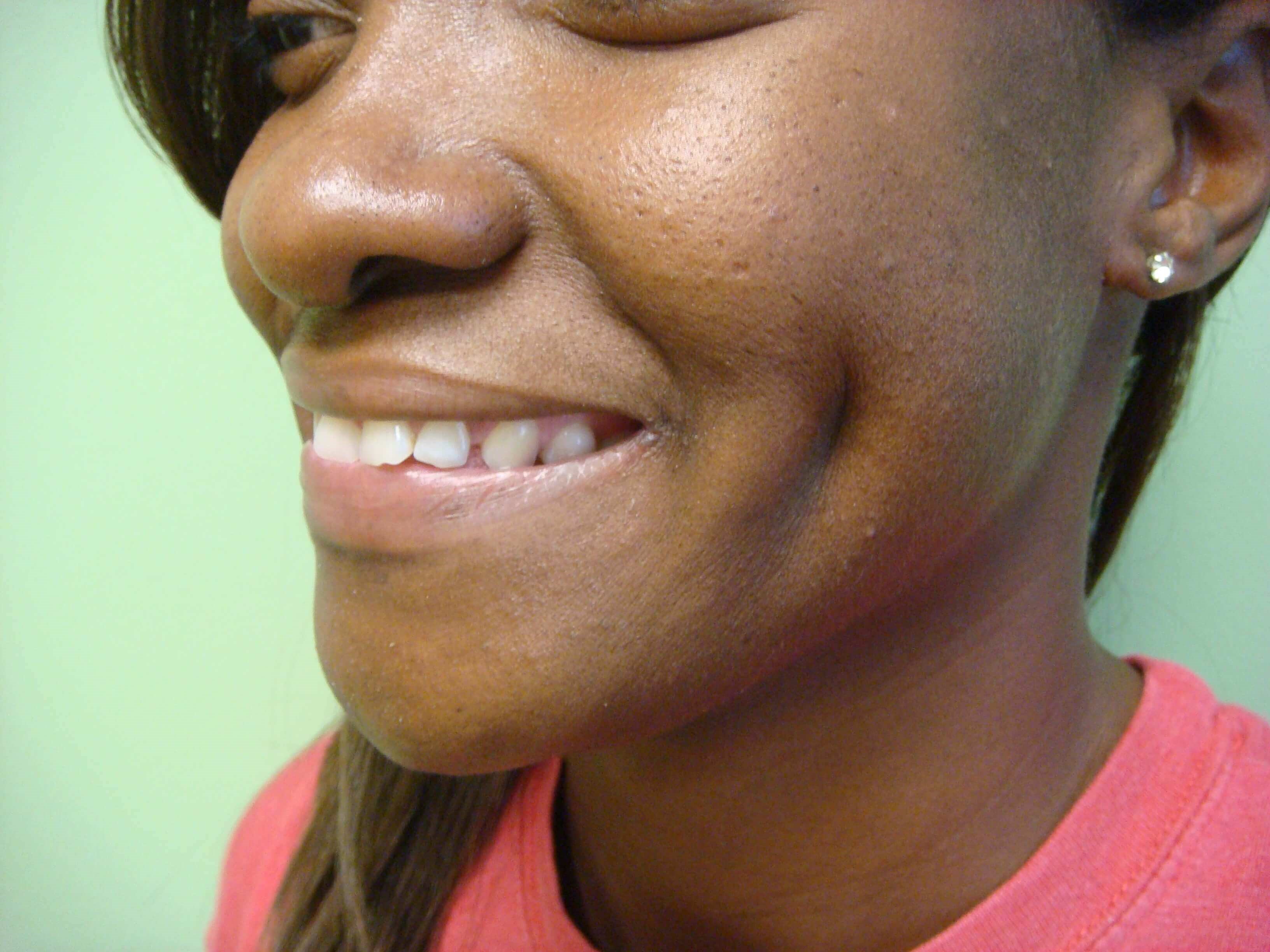Timeless Dimple (Dimpleplasty) After