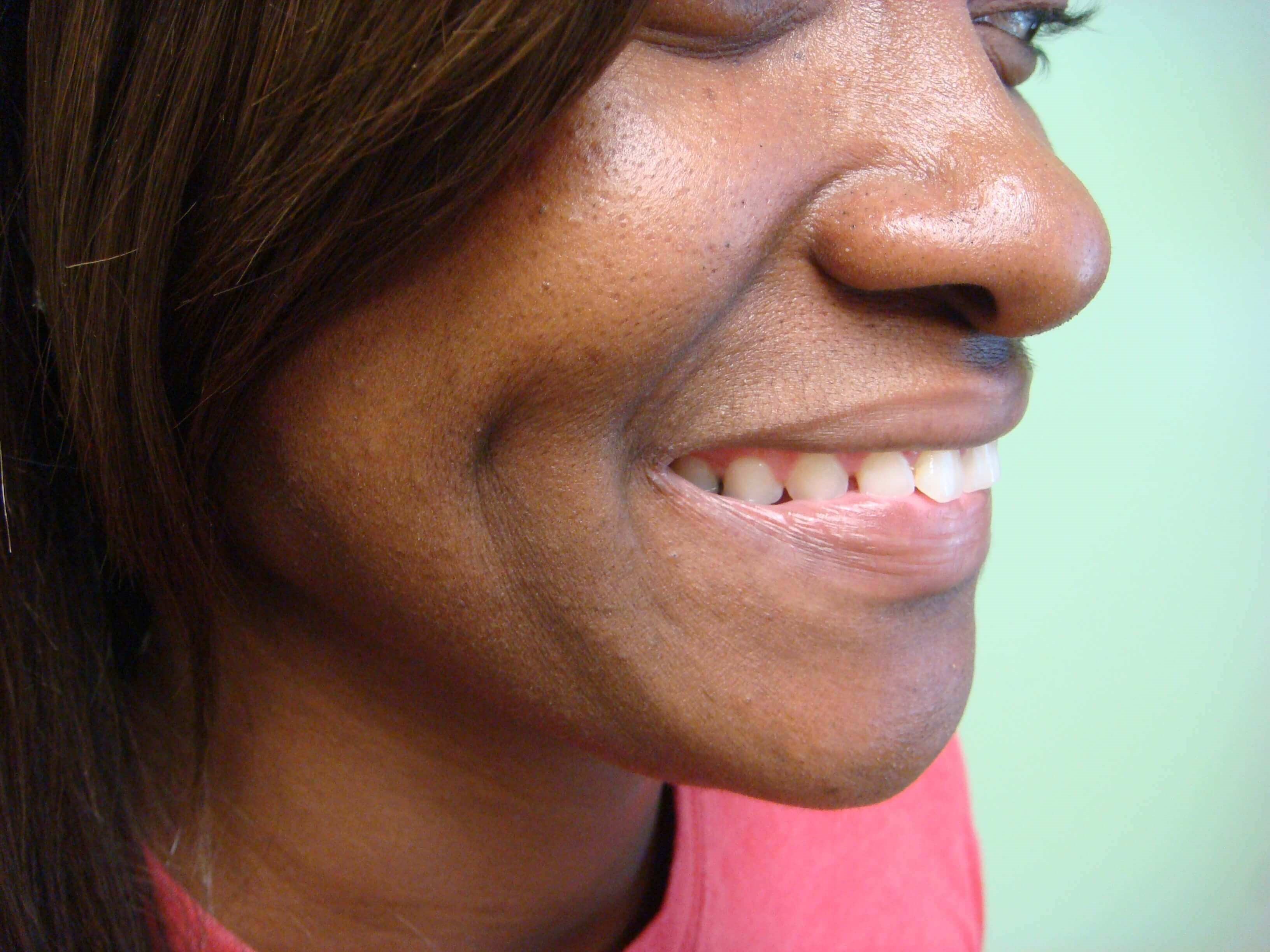 Timeless Dimple (Dimpleplasty) After