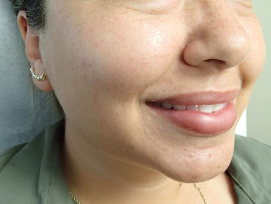 Timeless Dimple (Dimpleplasty) Before