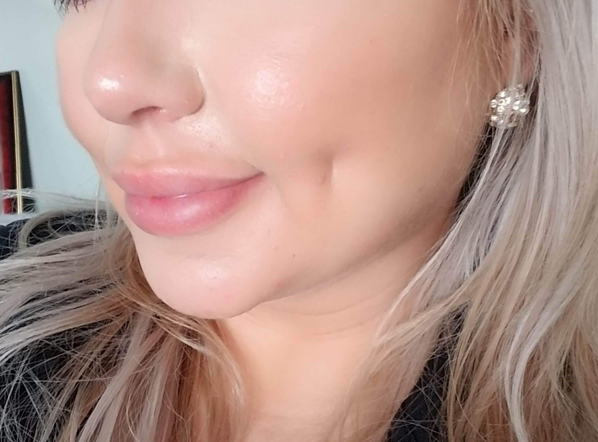 Timeless Dimple (Dimpleplasty) After
