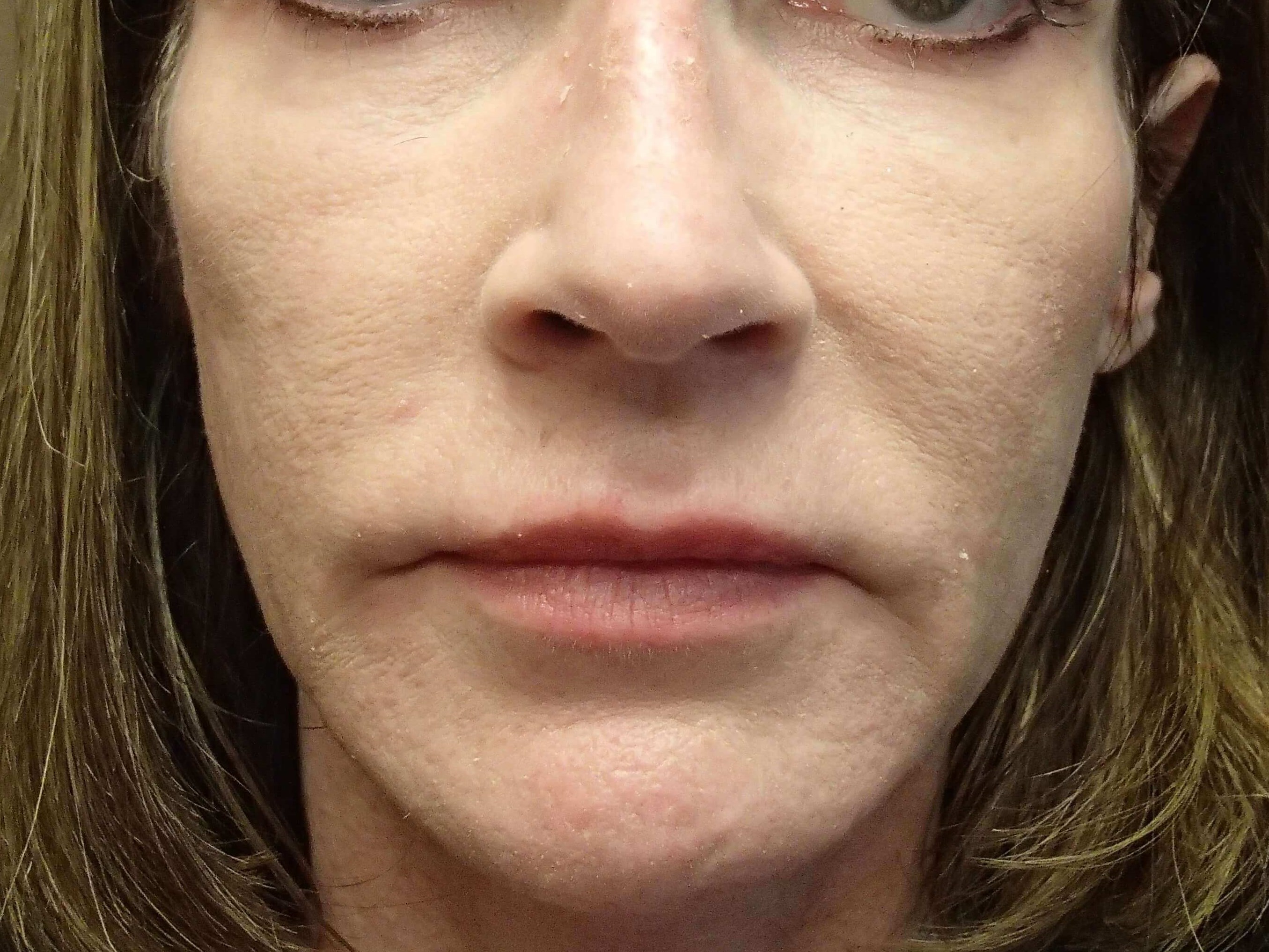Laser Skin Resurfacing Before
