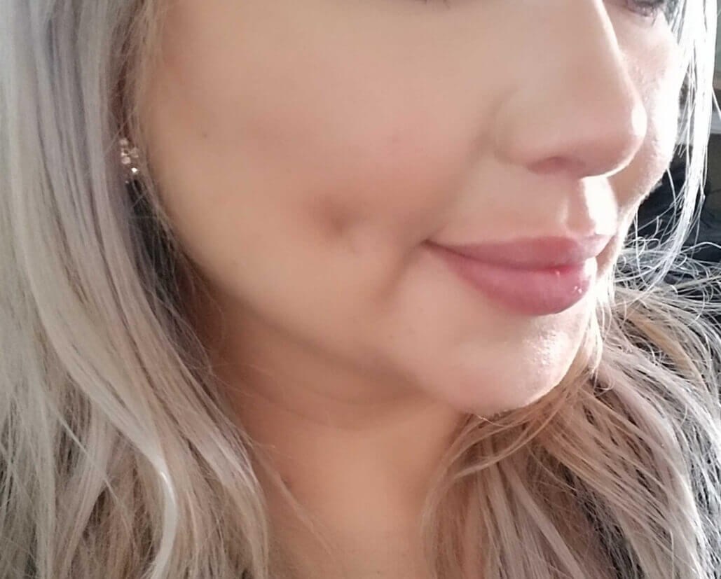 Timeless Dimple (Dimpleplasty) After