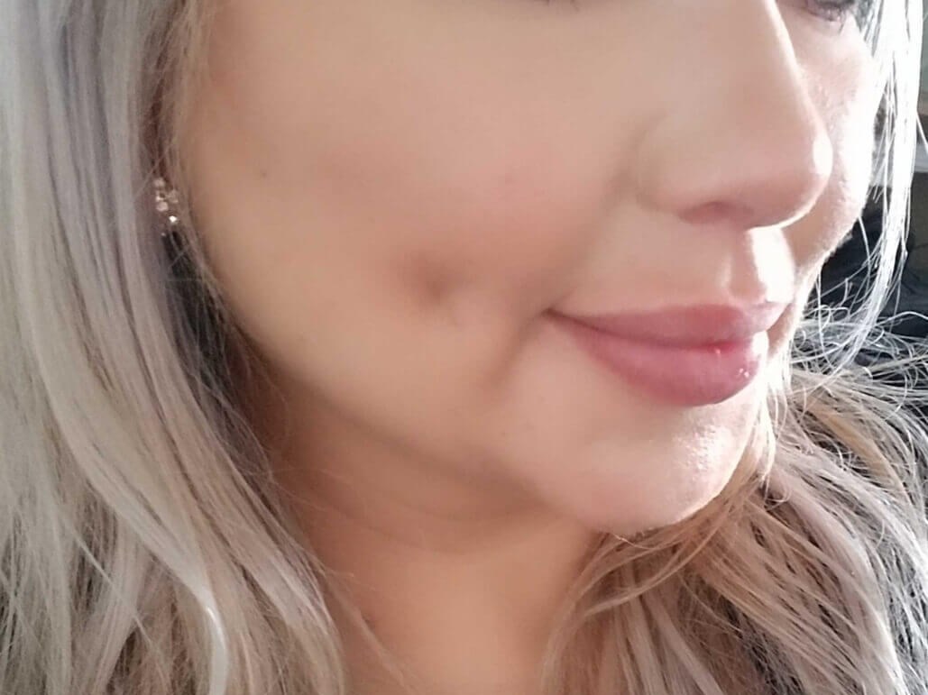 Timeless Dimple (Dimpleplasty) After