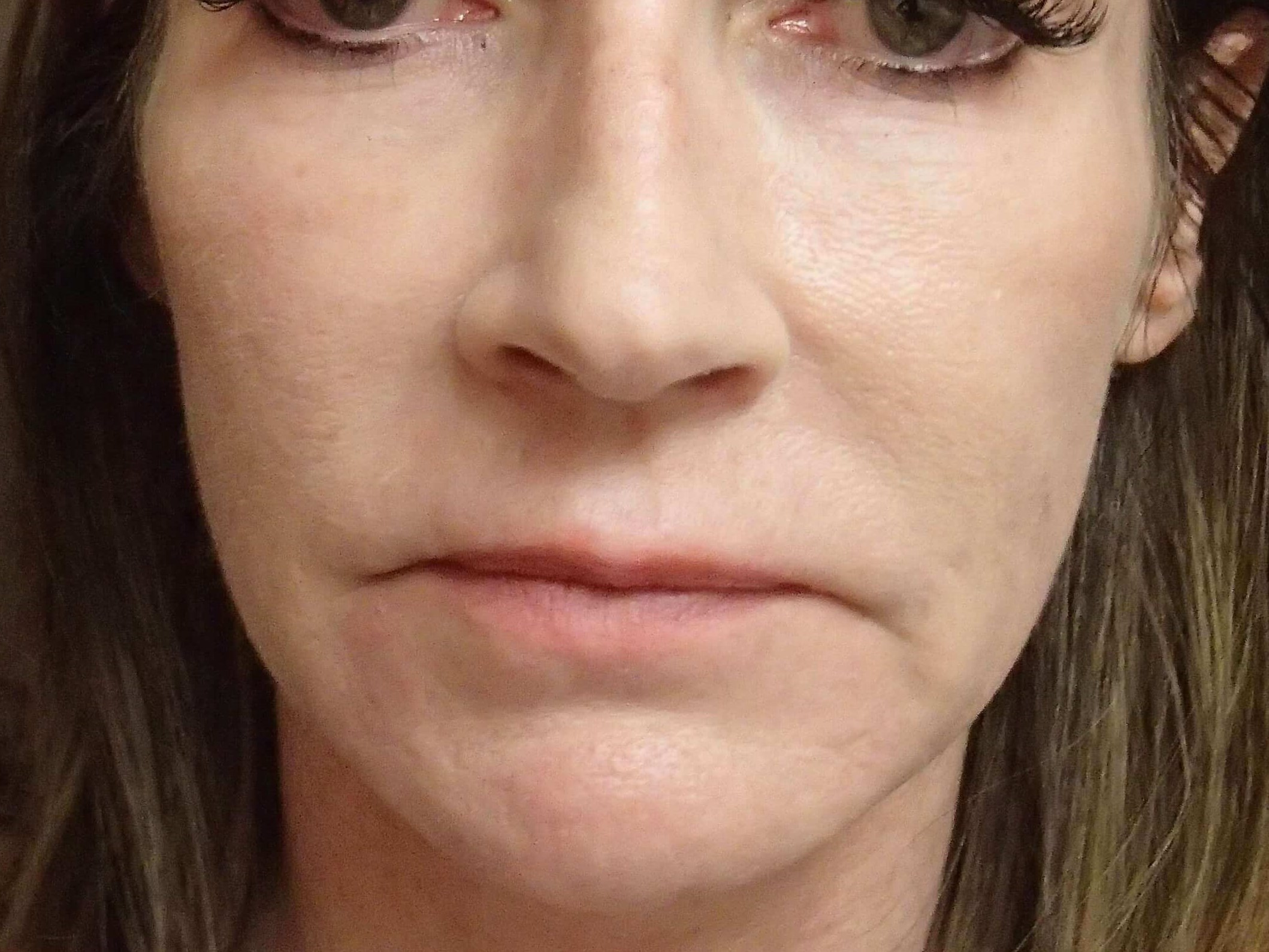 Laser Skin Resurfacing After