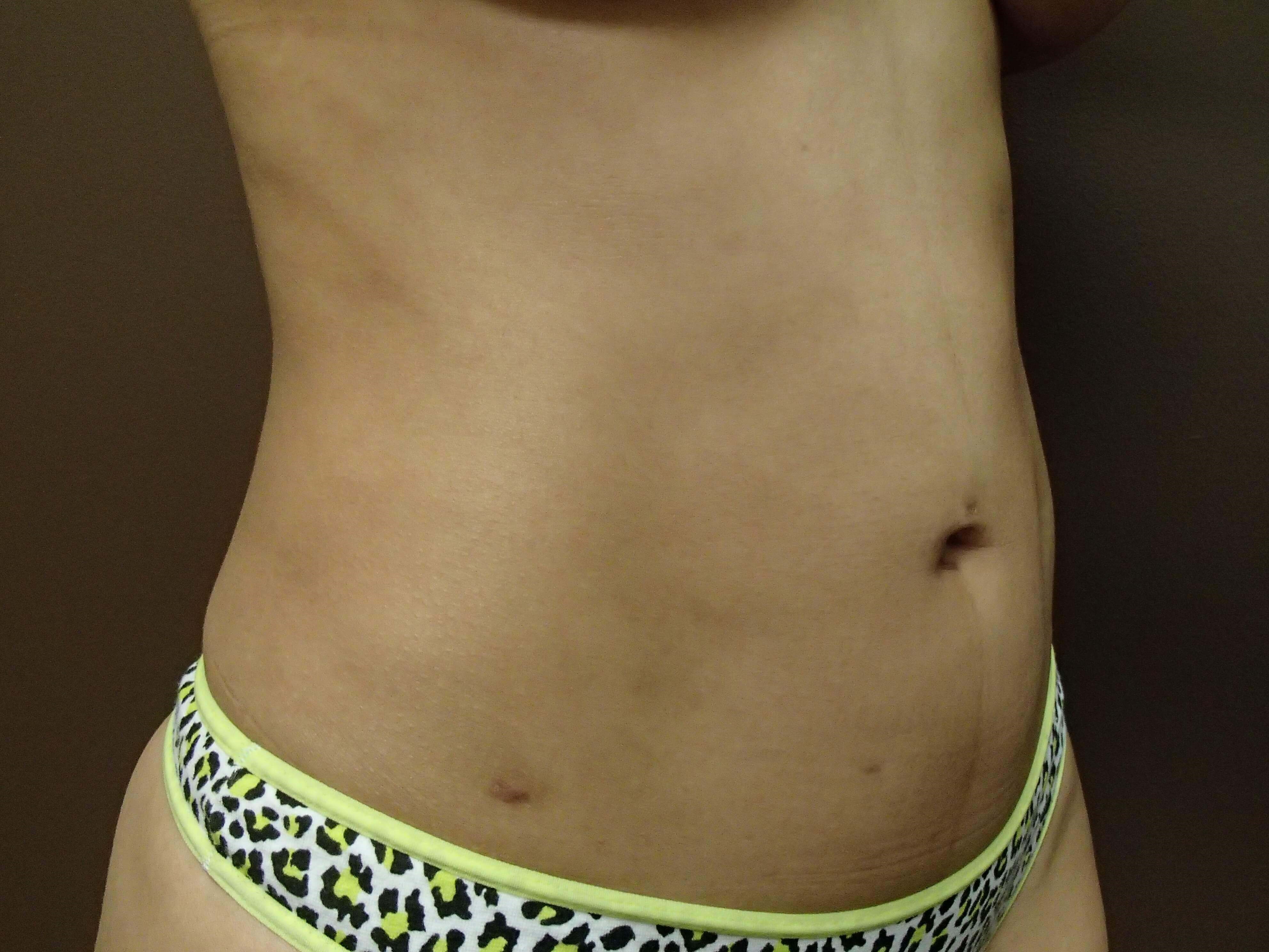 Liposuction After