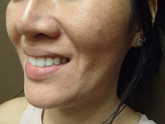 Timeless Dimple (Dimpleplasty) Before