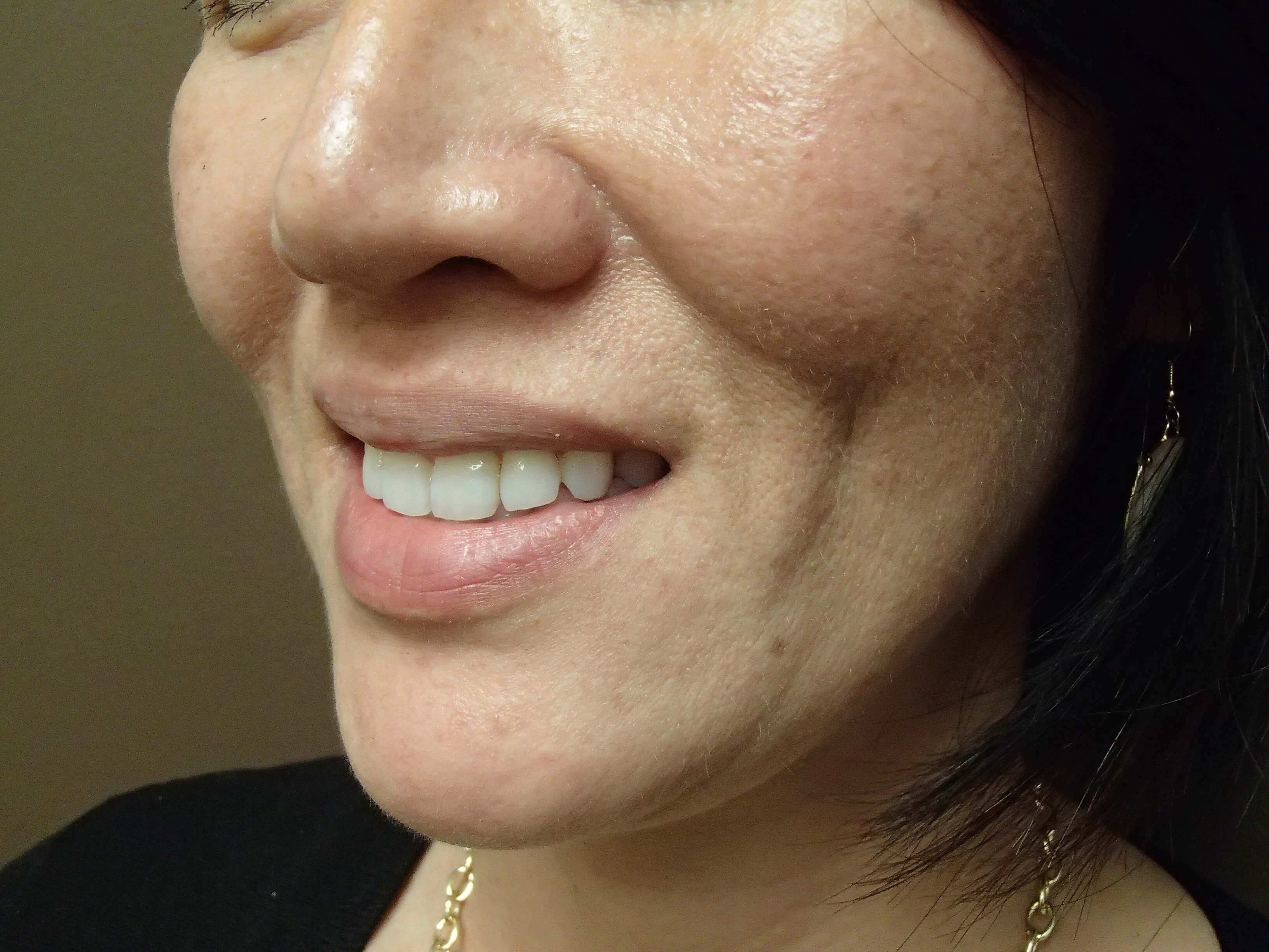 Timeless Dimple (Dimpleplasty) After