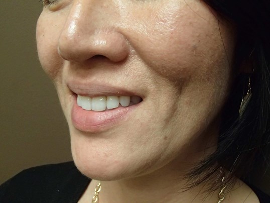 Timeless Dimple (Dimpleplasty) After