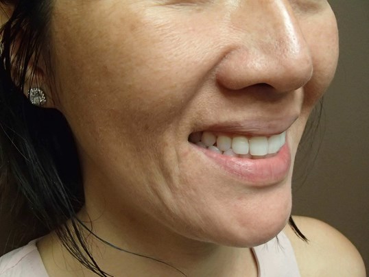 Timeless Dimple (Dimpleplasty) Before