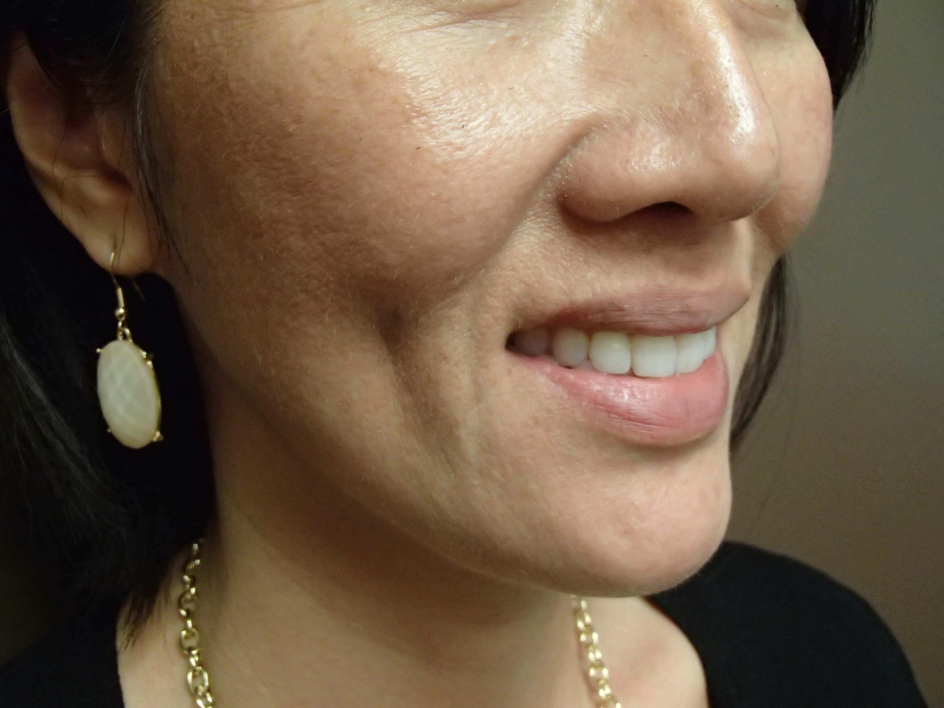 Timeless Dimple (Dimpleplasty) After