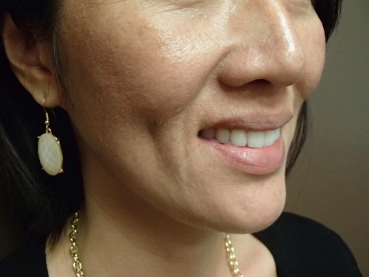 Timeless Dimple (Dimpleplasty) After