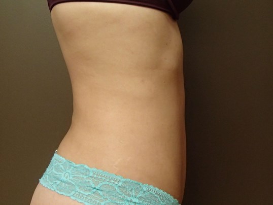 Liposuction After