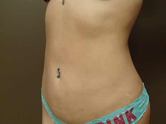 Liposuction After