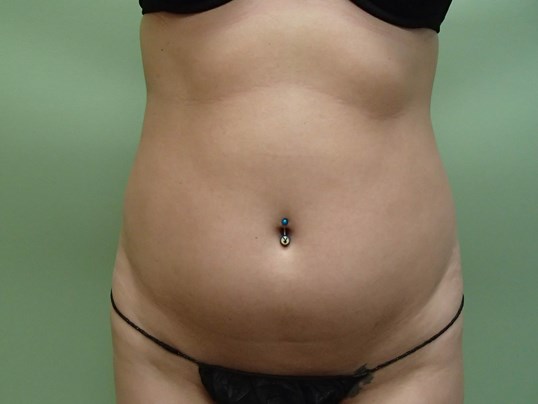 Liposuction Before