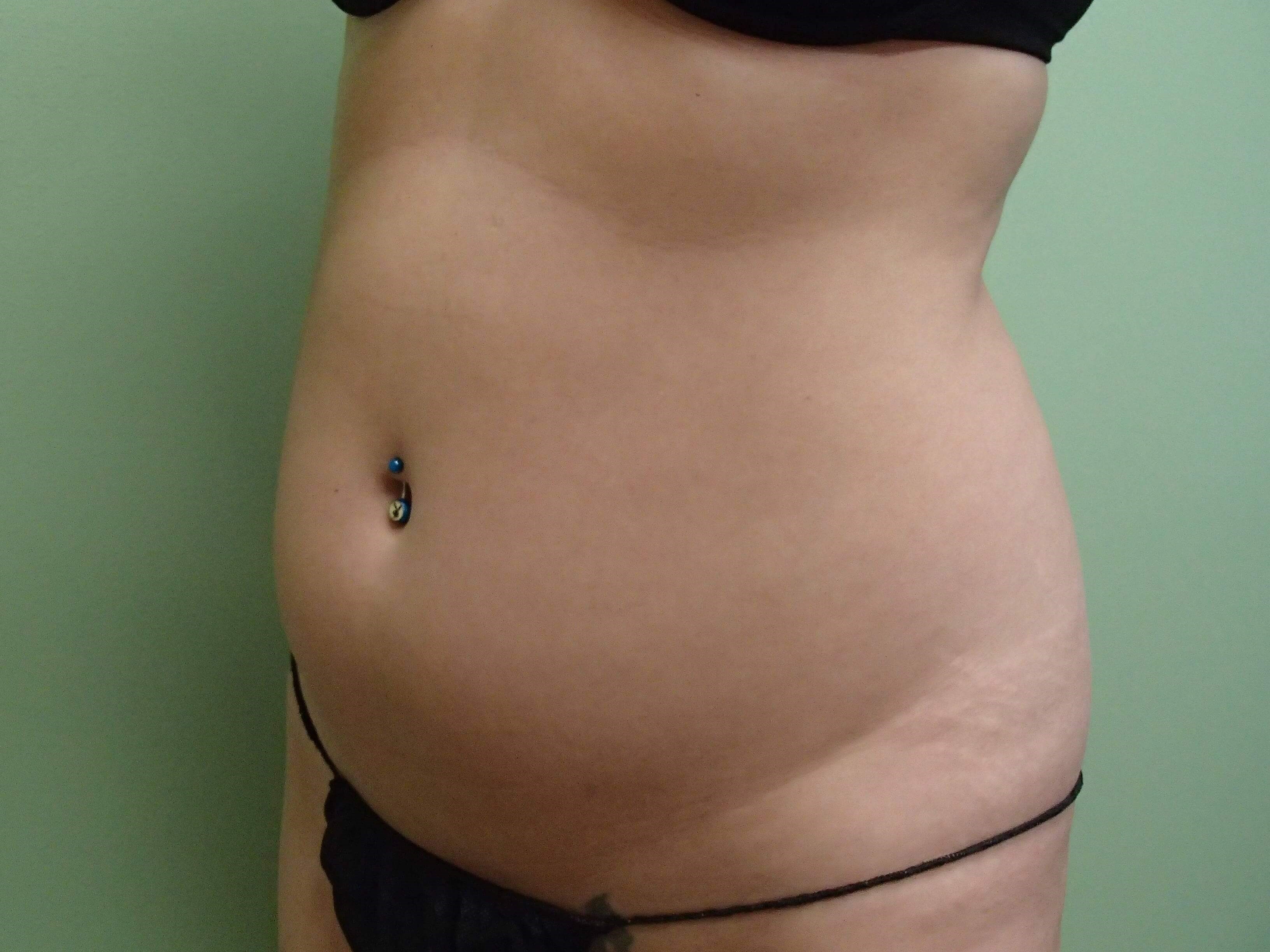 Liposuction Before