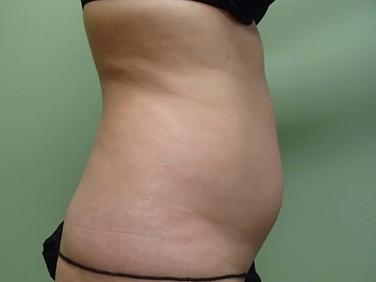 Liposuction Before