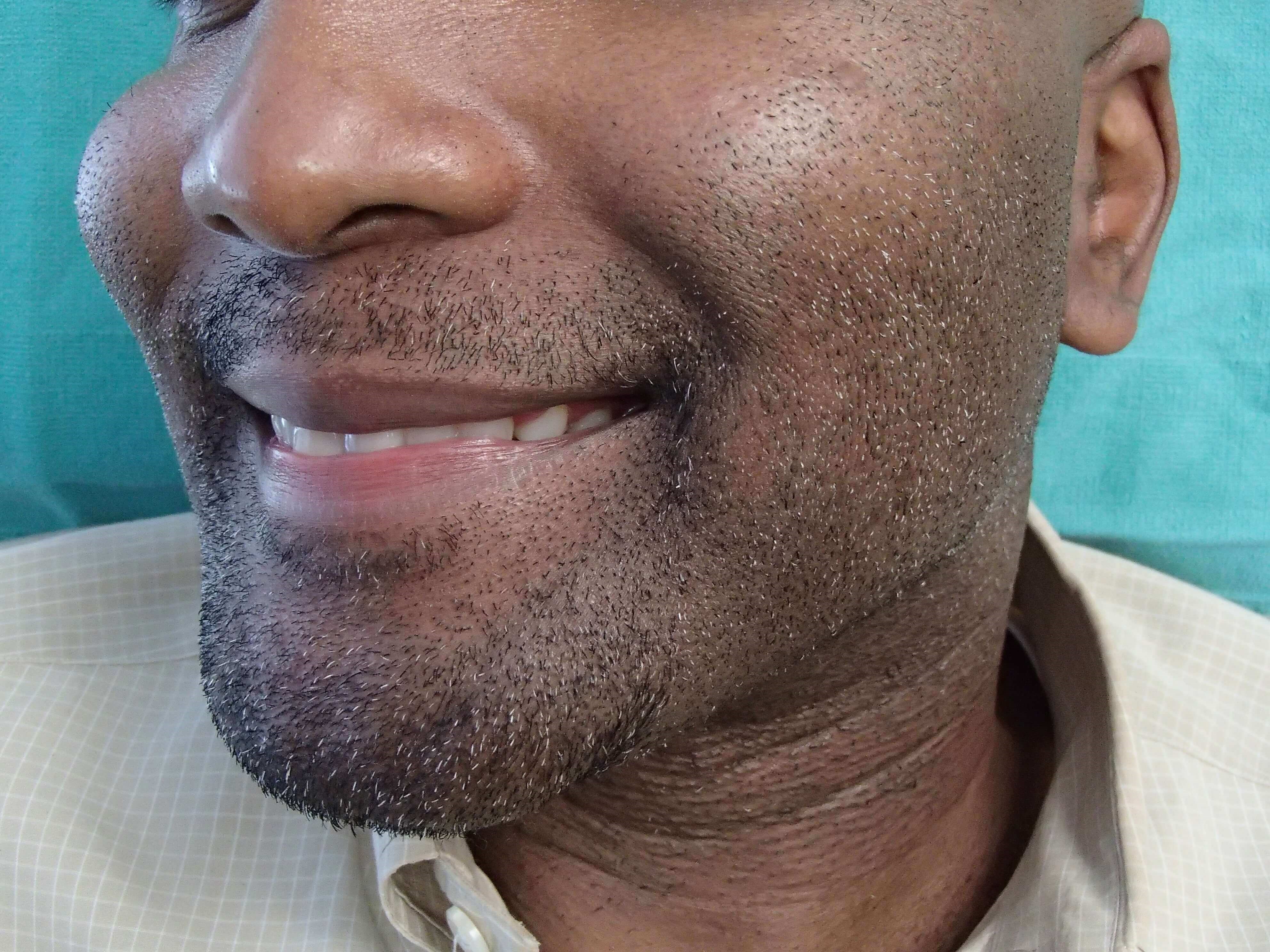 Timeless Dimple (Dimpleplasty) Before