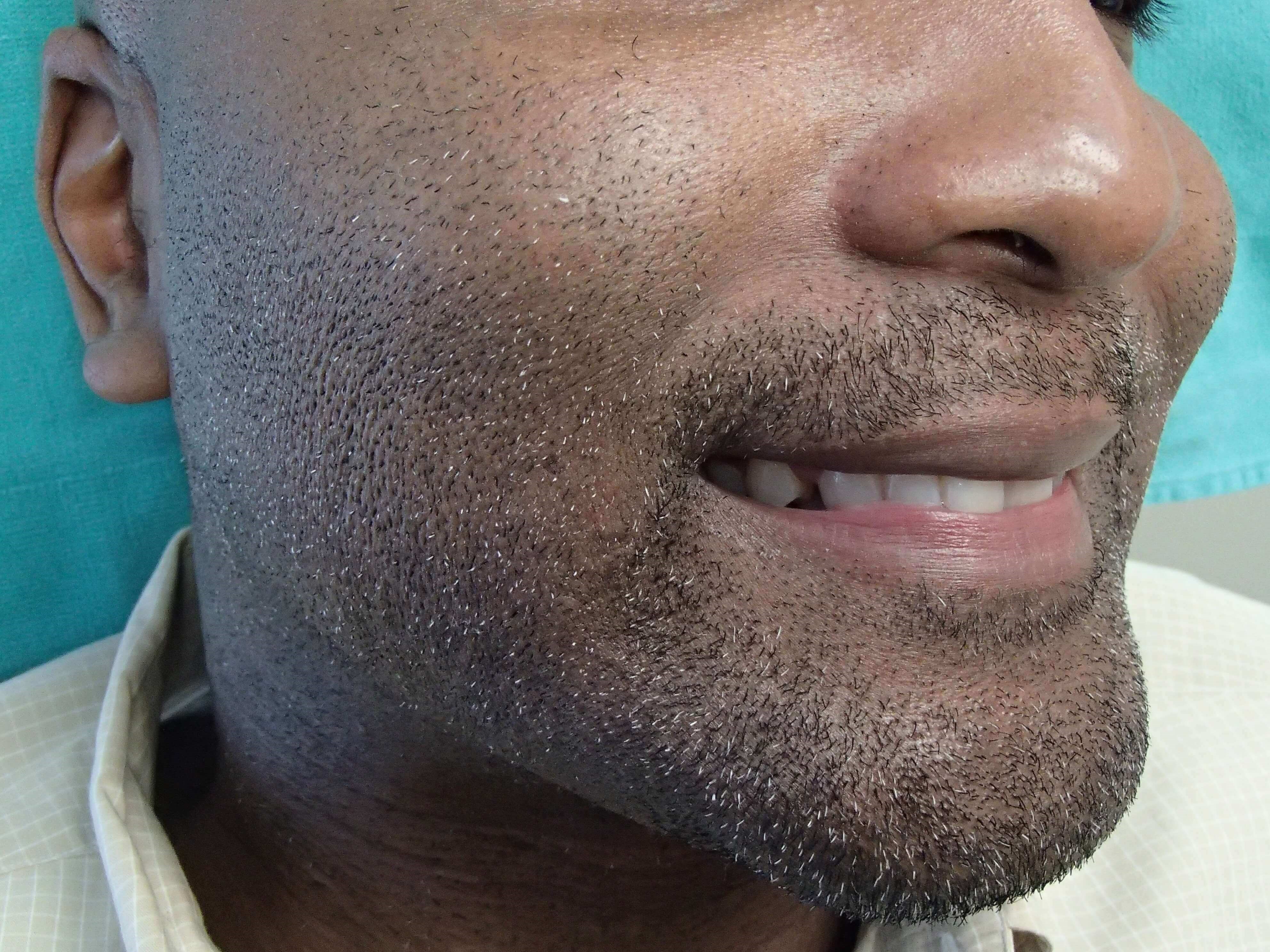 Timeless Dimple (Dimpleplasty) Before