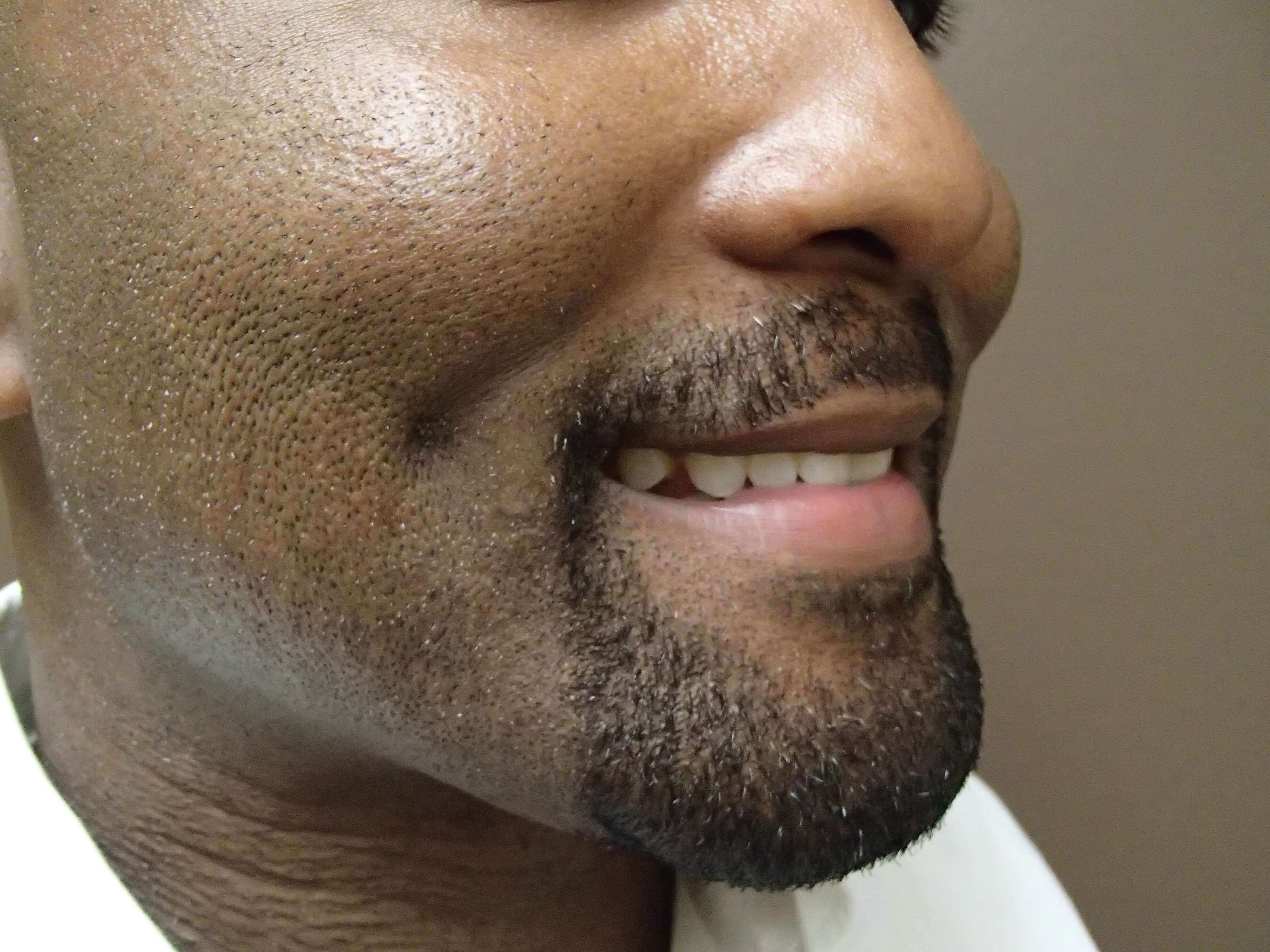 Timeless Dimple (Dimpleplasty) After